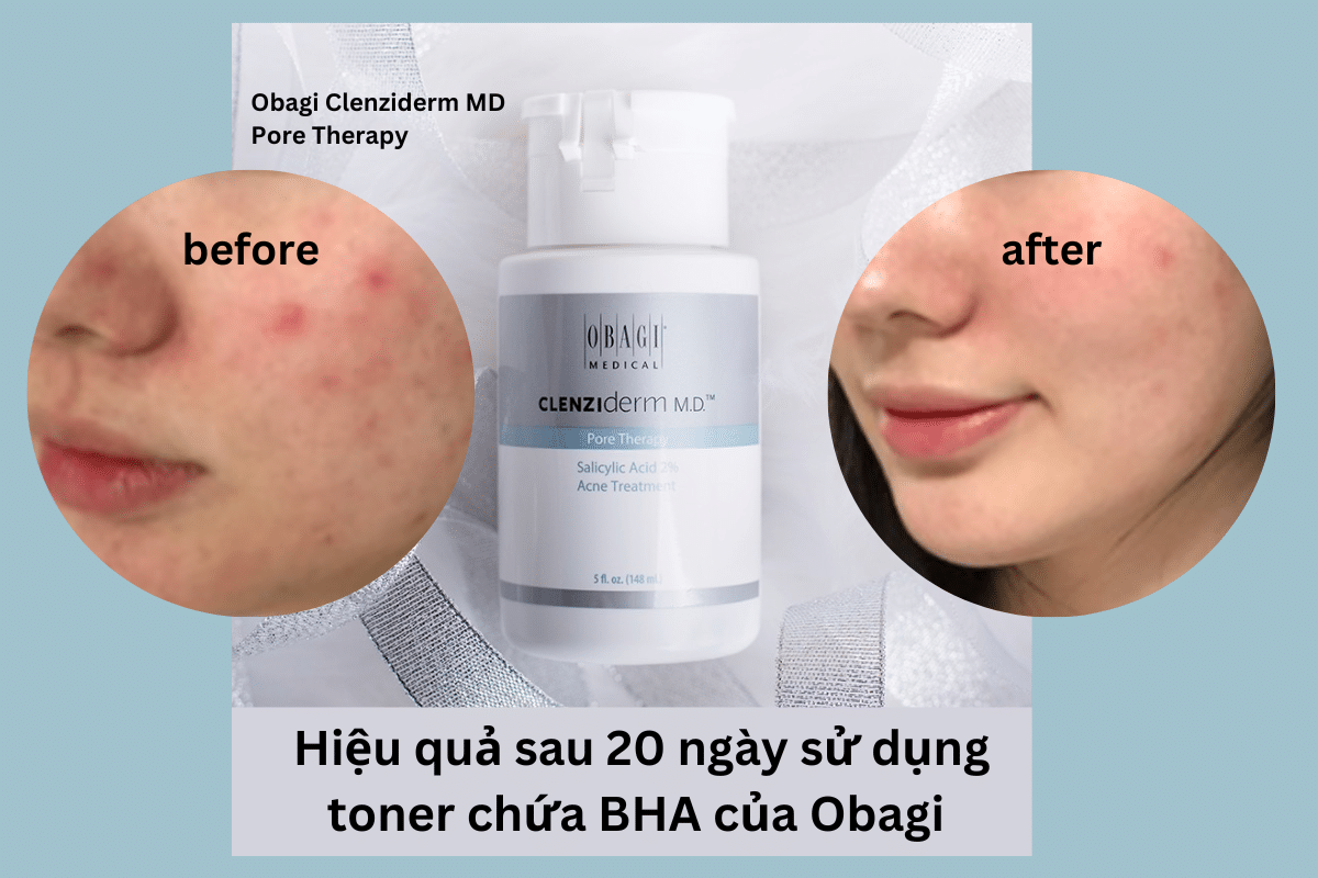 Hiệu quả sau 20 ngày sử dụng toner chứa BHA - Obagi Clenziderm MD Pore Therapy 