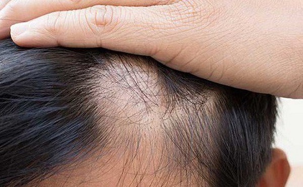 Hói đầu hoặc rụng tóc cũng là một trong những bệnh lý có liên quan đến di truyền.
