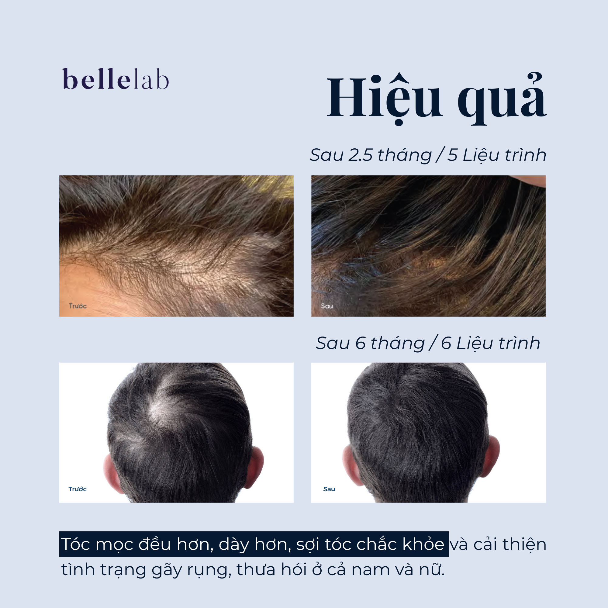 Hiệu quả của AnteAGE Home Hair System