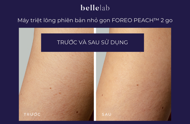 trước và sau sử dụng Máy triệt lông phiên bản nhỏ gọn – FOREO PEACH™ 2 go