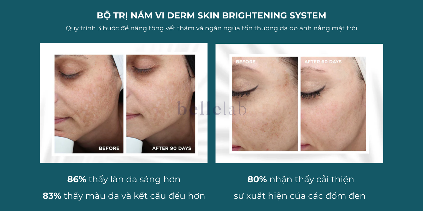 Kết quả lâm sàng khi sử dụng bộ trị nám VI DERM Skin Brightening System