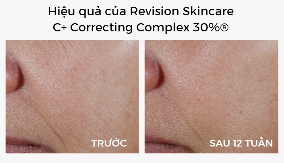 Hiệu quả của Revision Skincare C+ Correcting Complex 30%®